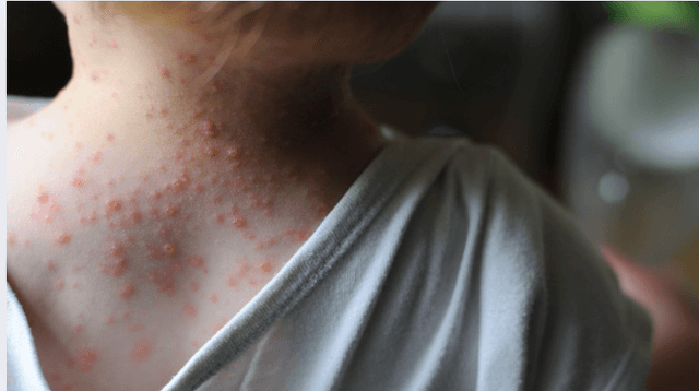Mpox