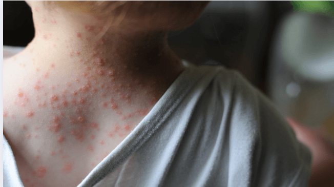Mpox