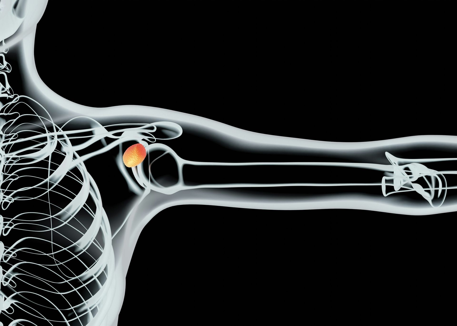 Atreon Orthopedics – BioCharge® Autobiologic Matrix Receives FDA 510(k) Clearance