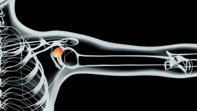 Atreon Orthopedics – BioCharge® Autobiologic Matrix Receives FDA 510(k) Clearance