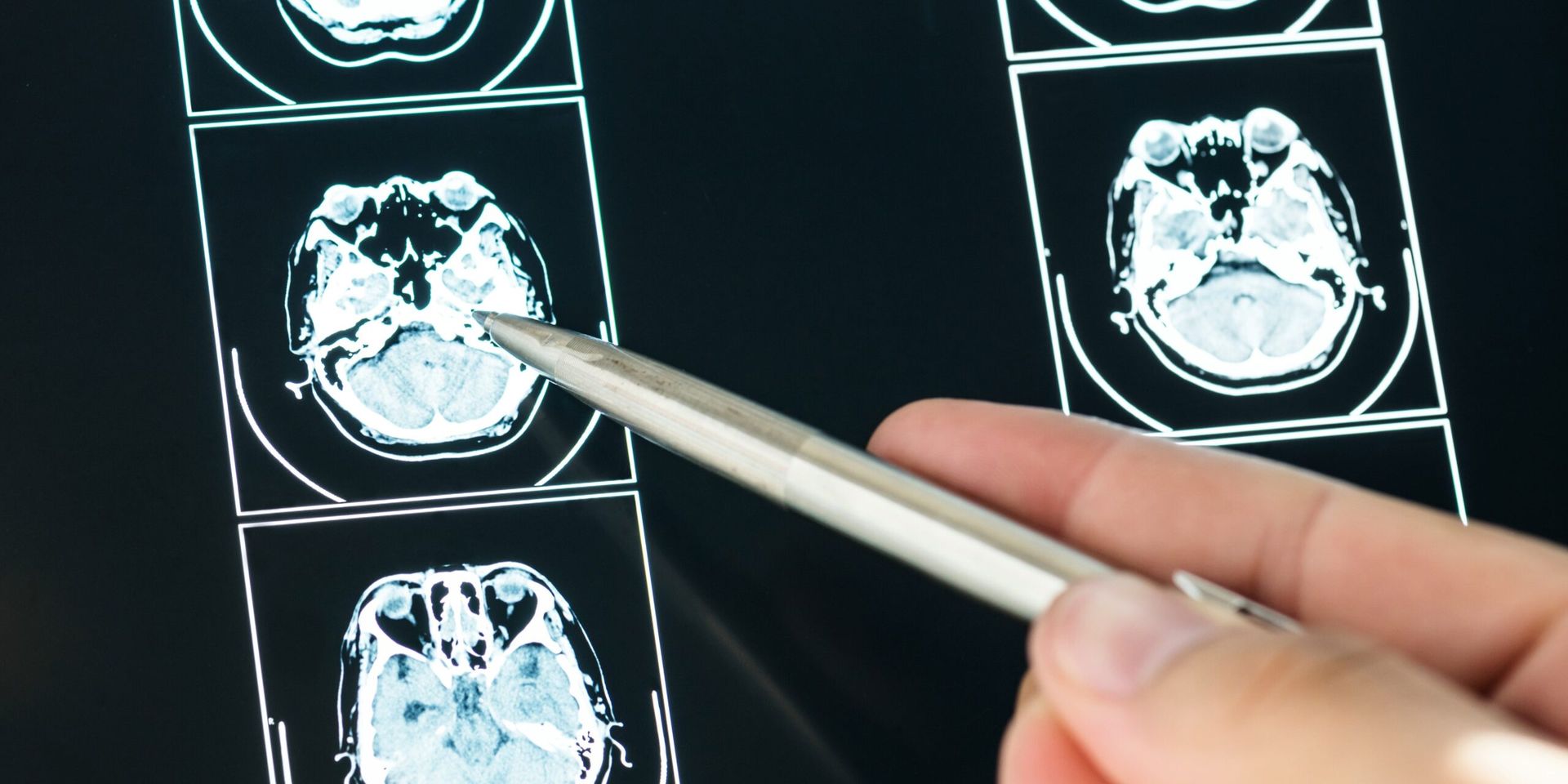AI Tool Detects Nine Types of Dementia from a Single Brain Scan