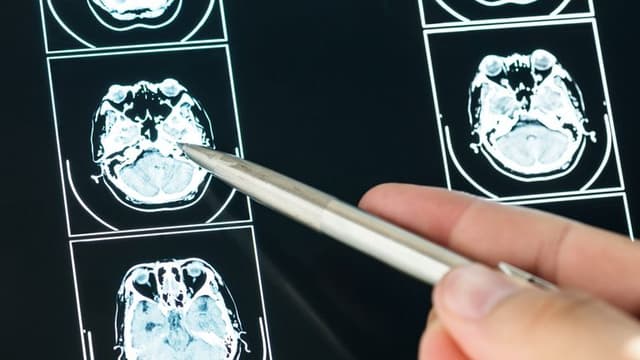 AI Tool Detects Nine Types of Dementia from a Single Brain Scan