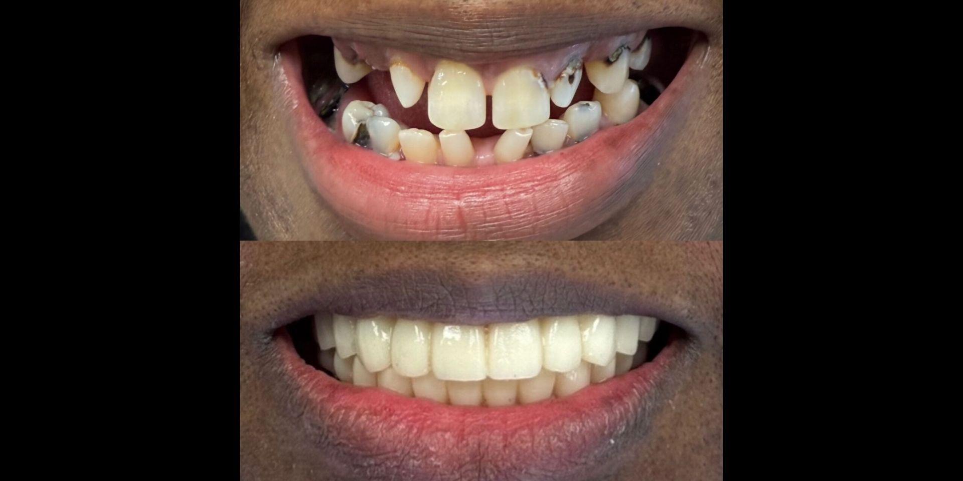 GD Dentistry Teeth In A Day Sets A New Standard In Affordable, Patient-Centered Dental Implant Care