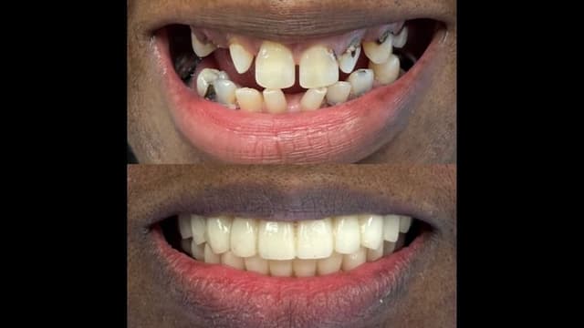 GD Dentistry Teeth In A Day Sets A New Standard In Affordable, Patient-Centered Dental Implant Care