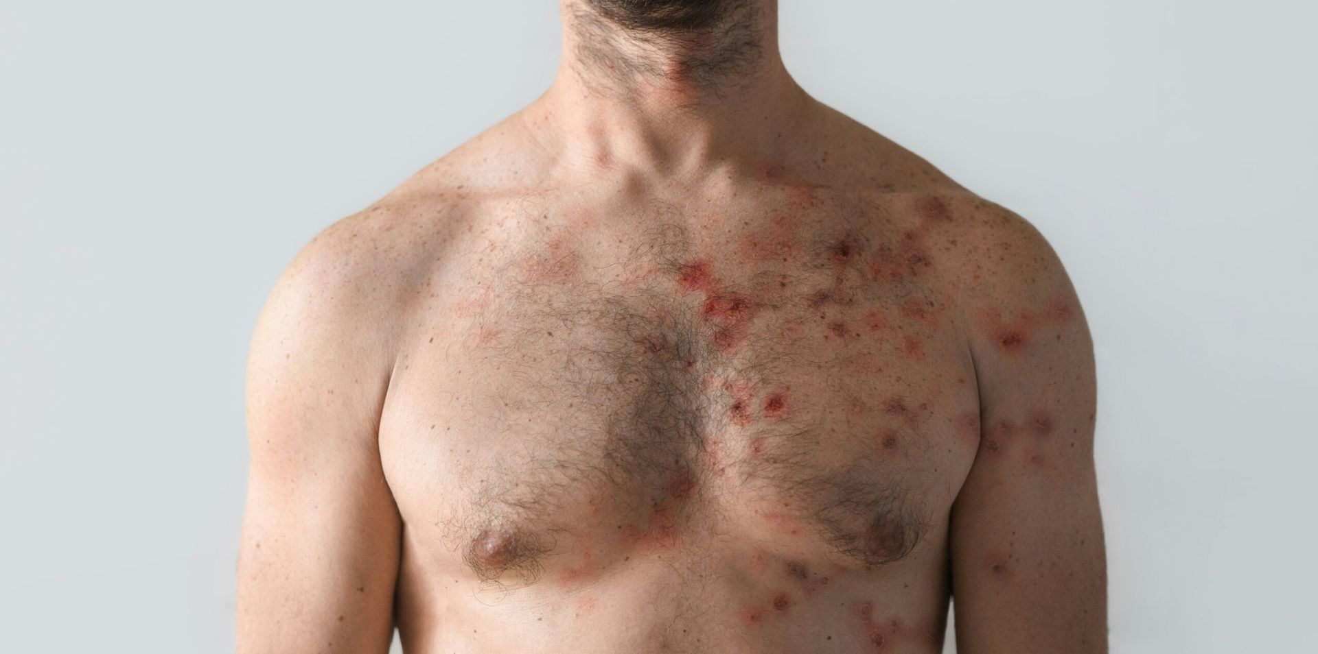 CDC Issues Health Alert Following Measles Exposure at Large Kentucky Gathering