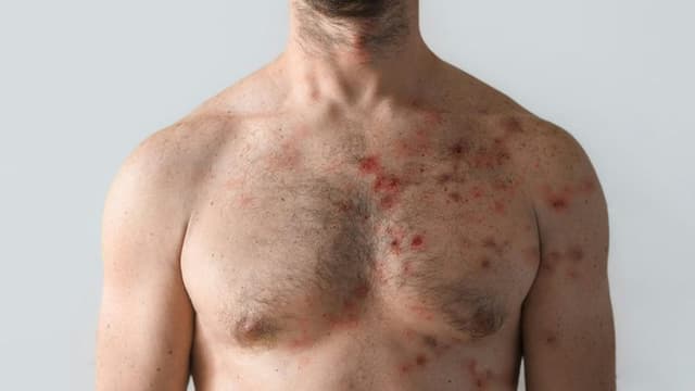 CDC Issues Health Alert Following Measles Exposure at Large Kentucky Gathering