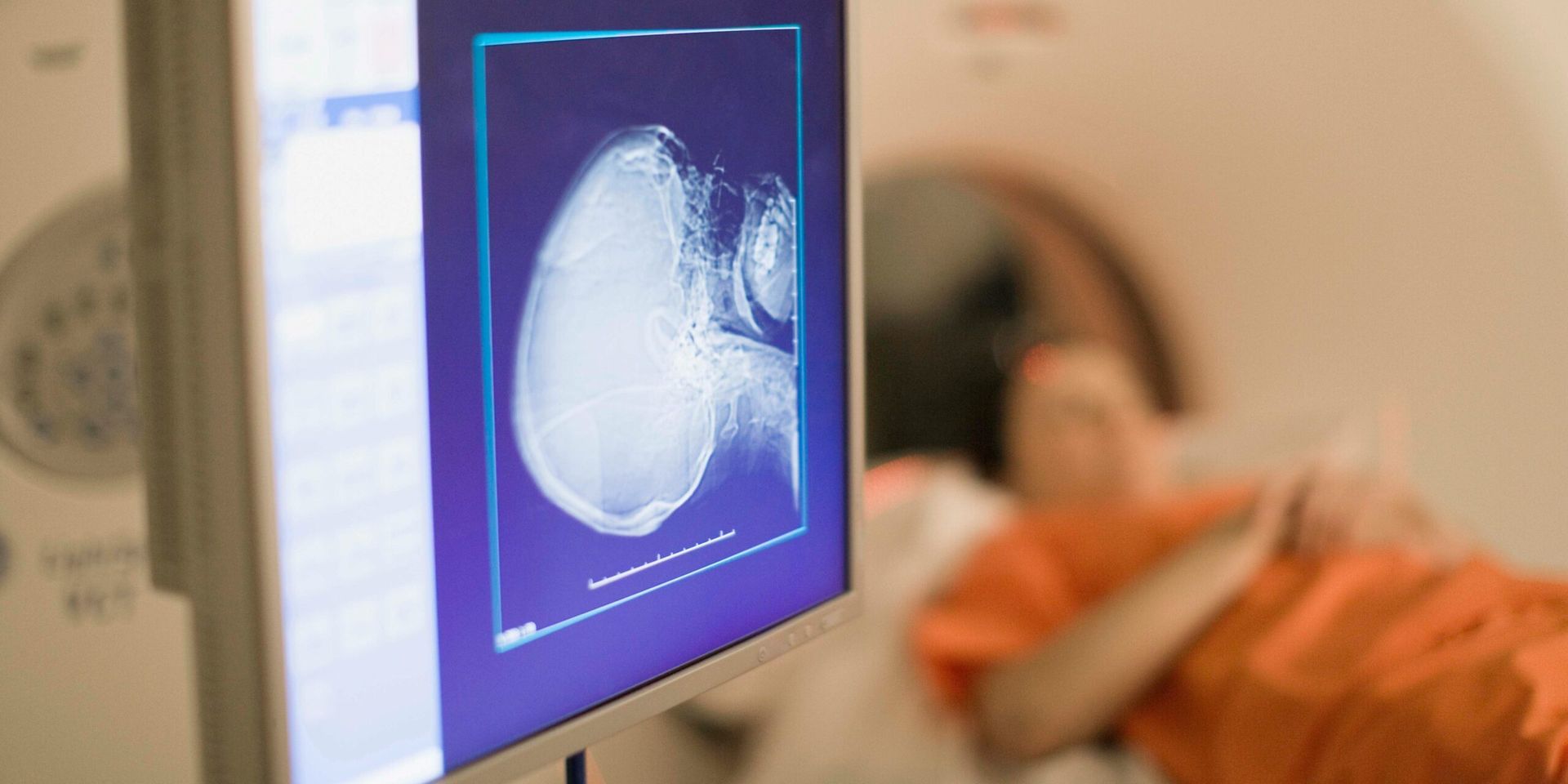 Mayo Clinic Initiates First-in-Human Trial of Targeted Radiopharmaceutical for Liver Cancer