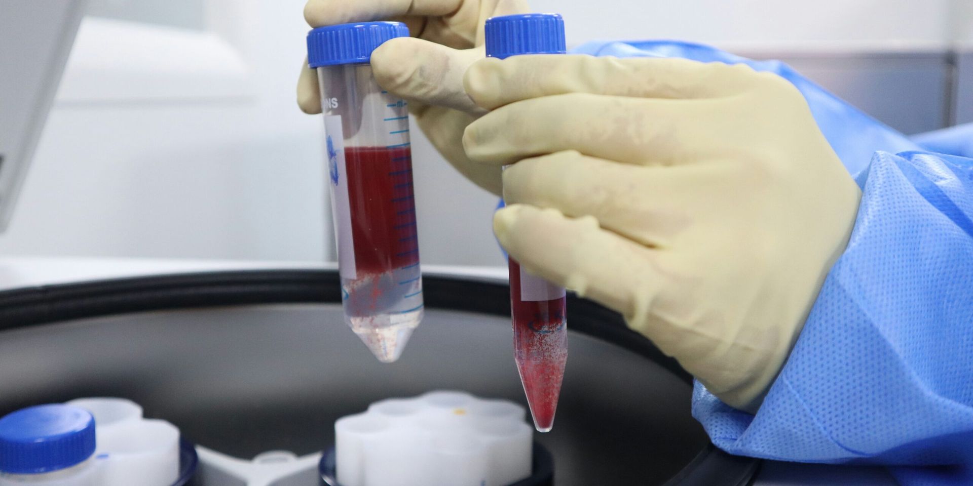 New Blood Test Detects HPV-Linked Cancers Years Before Diagnosis