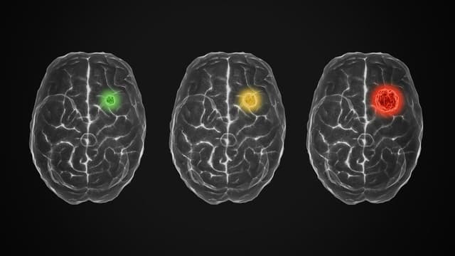ChatGPT Helps Pinpoint Precise Locations of Seizures in the Brain, Aiding Neurosurgeons